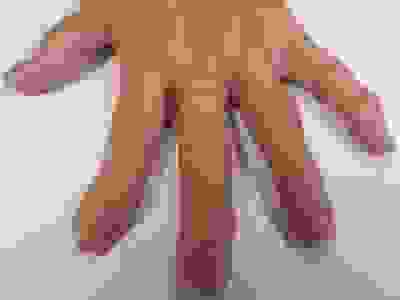 Osteoarthritis Acupuncture Best Professor Yoland Lim Australia Melbourne Dr Justin Lim treatment