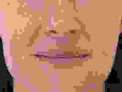 SLE Skin Treatment Dr Justin Lim Dr Selina Lim Professor Yoland Lim Health Care Laser JUVEFACE skin