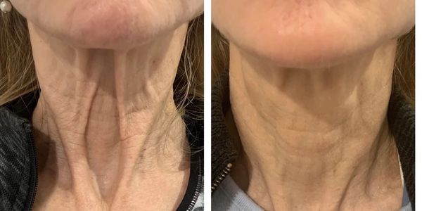 microneedling for the neck & décolleté anti-aging for neck and hands before and after microneedling