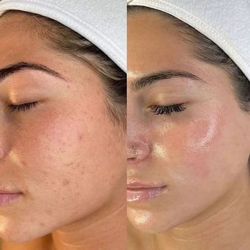 Before and after skincare treatment showing clearer, glowing skin.