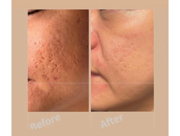 Transform your skin and hair with our specialized treatments. We offer effective solutions for acne,