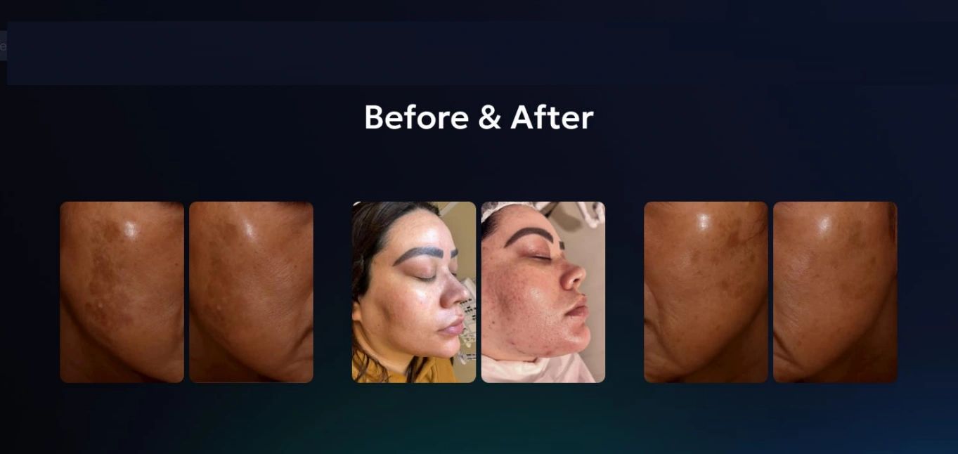 Before and after images showing improved facial skin texture and clarity.