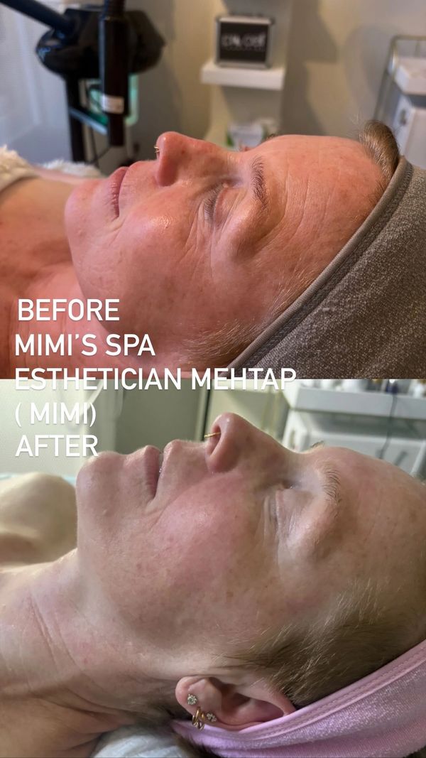 Before and after facial treatment at Mimi's Spa by esthetician Mehtap.
