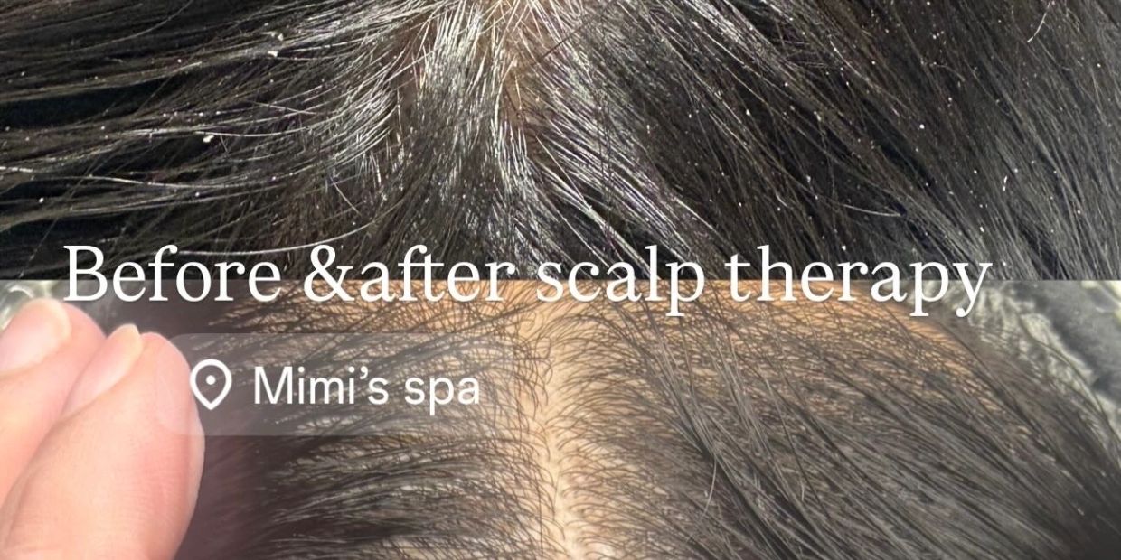 Before and after scalp therapy showing improved scalp health.