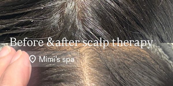 Before and after scalp therapy showing improved scalp health.
