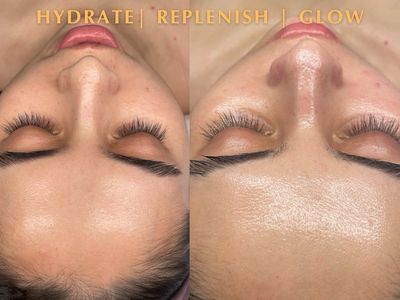 BioRePeel Chemical Peel & facial package deal