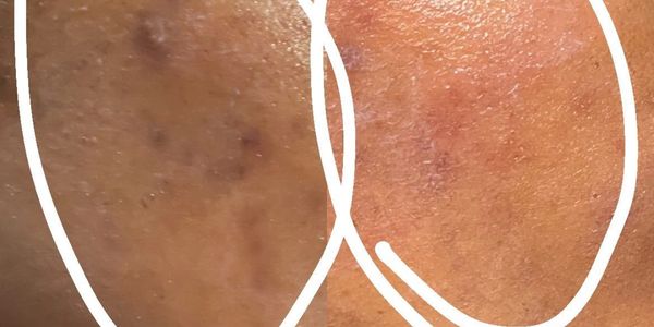 “Chemical Peel Brookhaven “