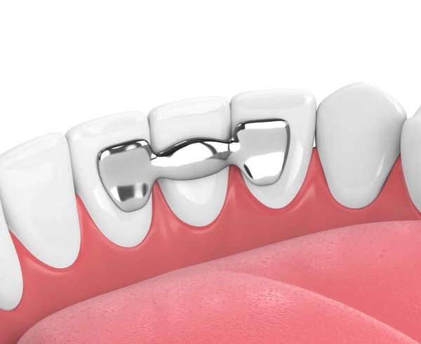 Dental Bridges