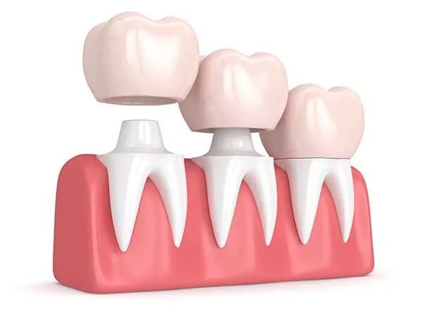 Dental Crown - AZ Family Dentistry