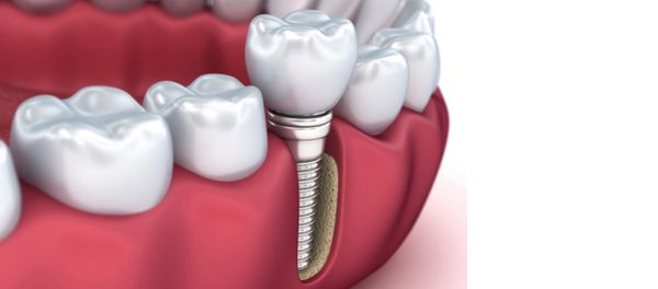 Wisdom teeth removal