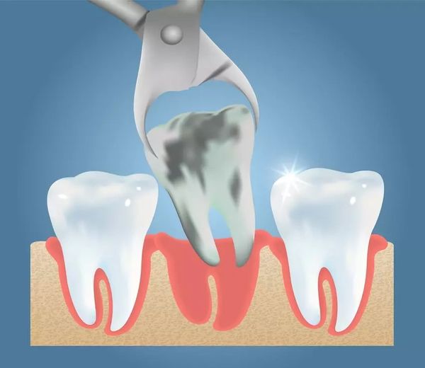 emergency tooth extraction