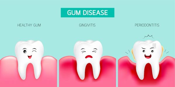 Gum disease treatment