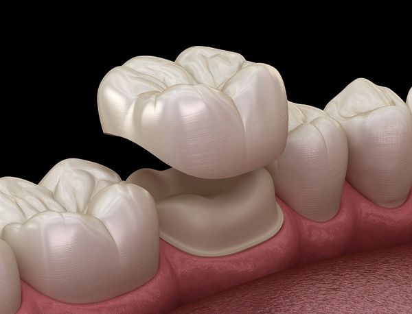 Dental Crowns