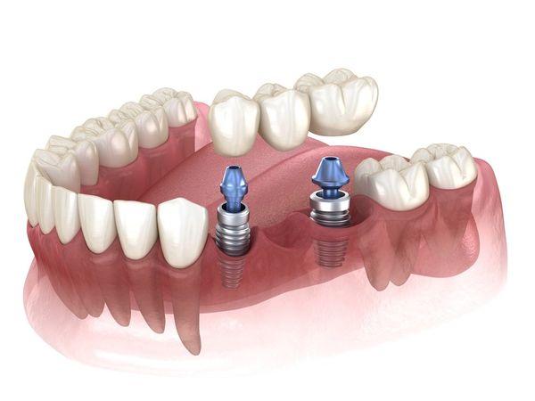 Cost of dental implants