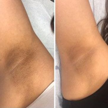 Comparison of underarm skin before and after treatment shows noticeable lightening.