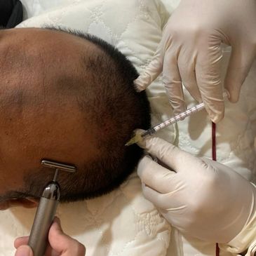 Medical procedure injecting scalp with syringe while using a tool on the head.