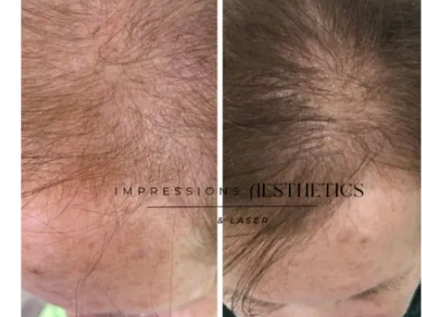 Before and after hair restoration treatment on a scalp.