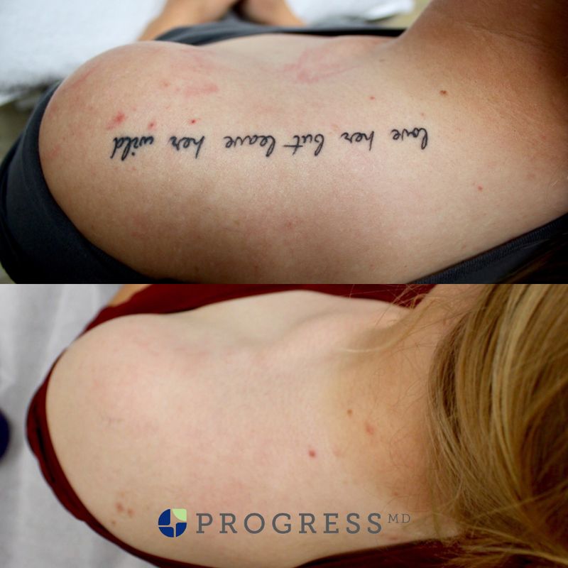 Tattoo Removal Cork Tattoo Design