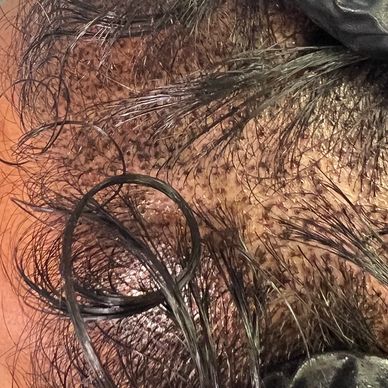 smp, scalp micropigmentation. scalp tattooing between the hair follicles to give a fuller look.