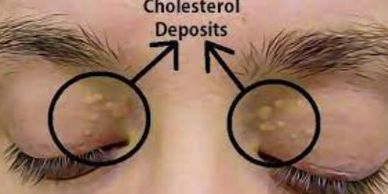 Cholesterol deposits, Cholesterol deposits around eyes.