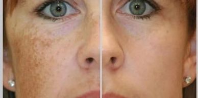 before and after skin imperfection removal.