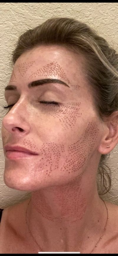 Patterns for Fibroblast skin tightening