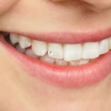 Teeth gems or sparkles are back!