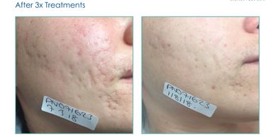 Mayfair MediSpa Skin Resurfacing 