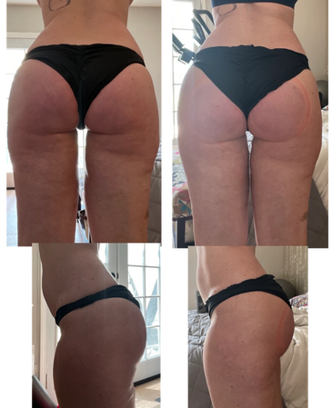 Butt Augmentation El Paso, Butt Lift