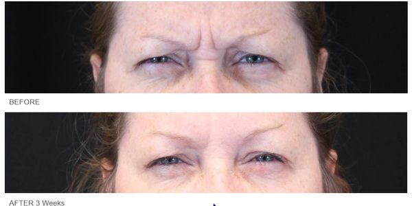 IMED SPA ST JOHNS, FL - Injectables results - Get rid of wrinkles - Botox, Jeuveau, Xeomin
