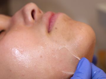 IMED SPA - Chemical Peel - Signature facial, microneeding, PRP, O2 facials, and more