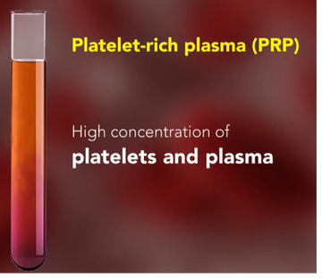 IMED SPA - PLATLET RICH PLASMA (PRP) Therapy