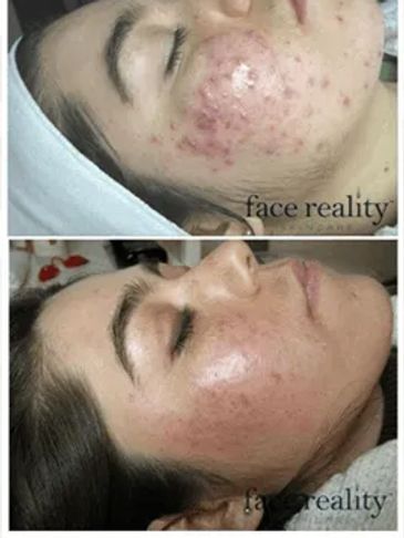 Woman before/after receiving acne control Imagine Wellness Spa Cape Coral with Face Reality skincare