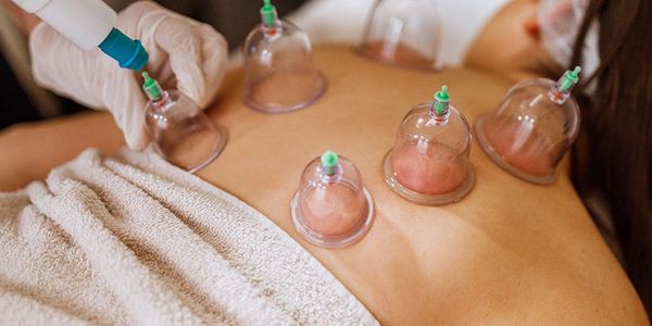 Cupping therapy being applied on a person's back.