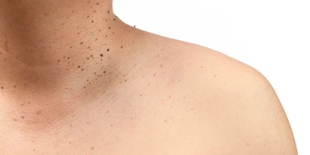 skin tags on neck