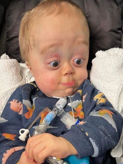 A toddler boy with MSS makes a funny face. He has a trach and ventilator.