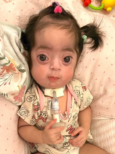 An infant girl with MSS looks at the camera with large brown eyes and pigtails in her dark hair.