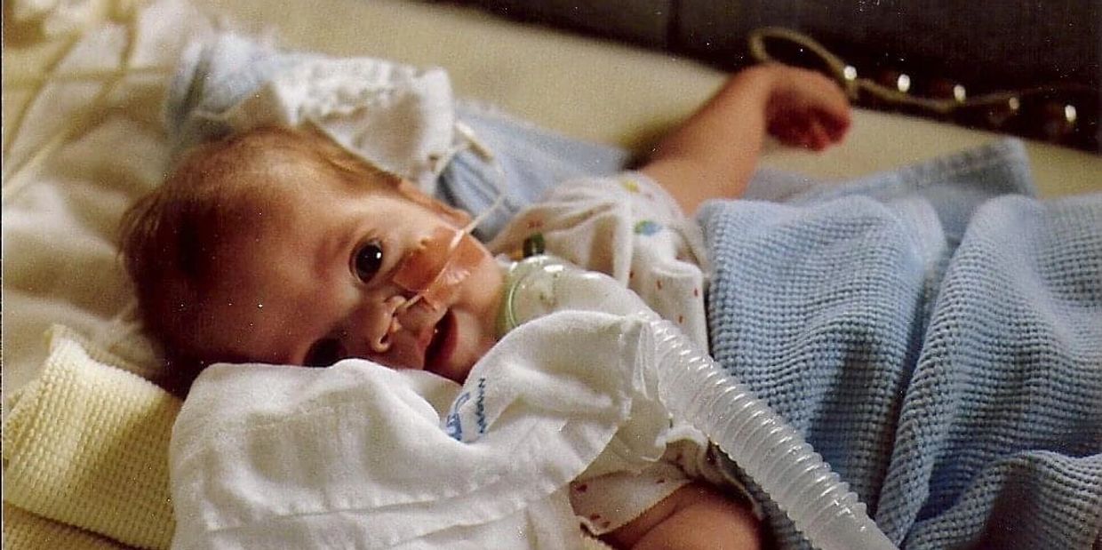 An infant with MSS lays in bed and smiles at the camera. He has a nasal feeding tube and tracheostom