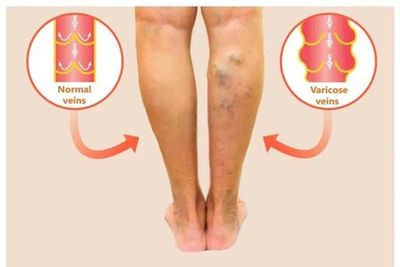 Comparison of normal and varicose veins in legs.
