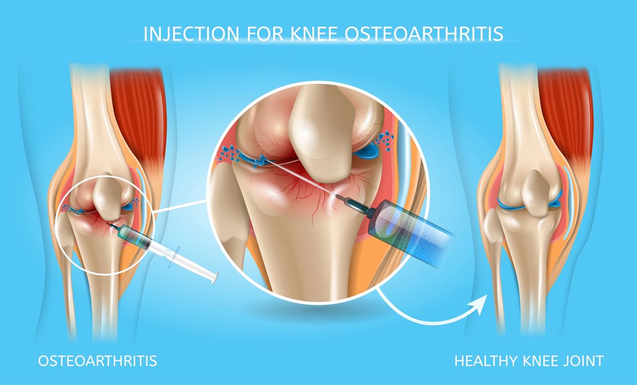 Injection for Knee Osteoarthritis. Injections for Joint Pain. Injections for Knee Pain 