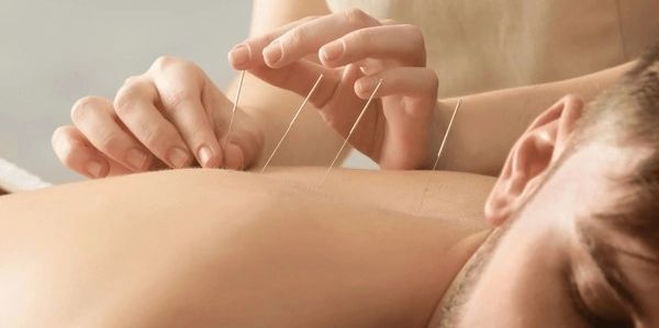 Acupuncture and dry needling at our Lyminton clinic 