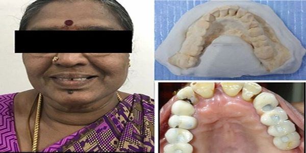 The diabetic patient successfully recovered with dental implants and bone augmentation 