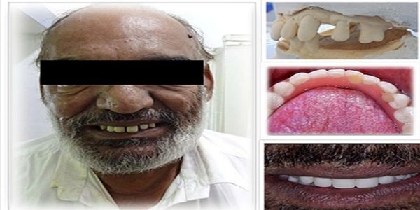 The patient with poor oral health has recovered and renewed his chewing ability 