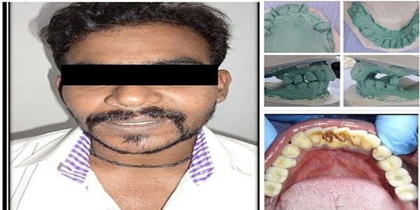 The patient recovered from multiple teeth losting and got his natural-looking tooth 