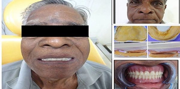 The patient with Arthritis regained his tooth loss from dental implants