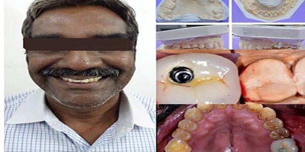 The patient recovered from missing tooth replacement with a permanent dental implant