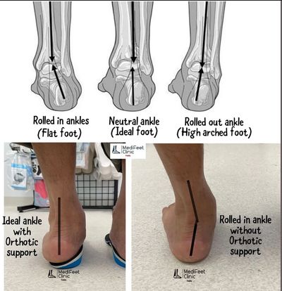 CUSTOM ORTHOTIC/ INSOLES