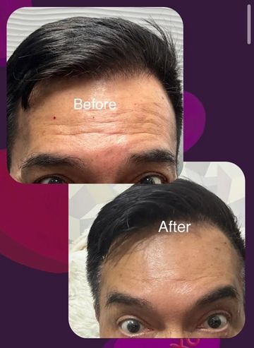 Botox Forehead