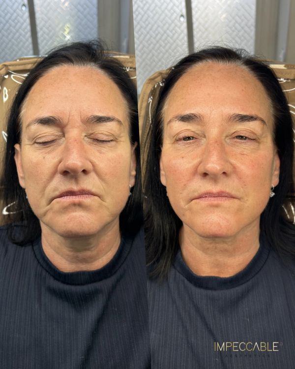 Before and after facial skin treatment comparison.