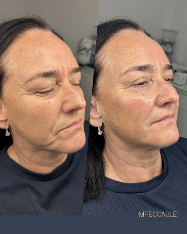 Before and after photo showing facial skin improvement.